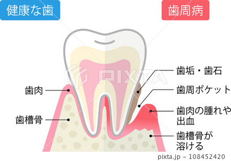 歯周病と健康な歯　比較　断面図 108452420