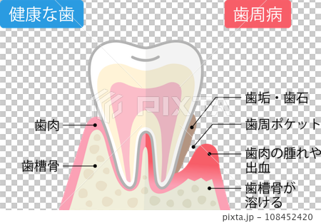 歯周病と健康な歯　比較　断面図 108452420