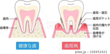 歯周病と健康な歯 比較 断面図 歯周病と健康な歯 比較 断面図 108452421