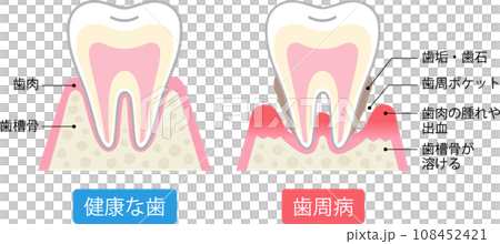 歯周病と健康な歯 比較 断面図 歯周病と健康な歯 比較 断面図 108452421