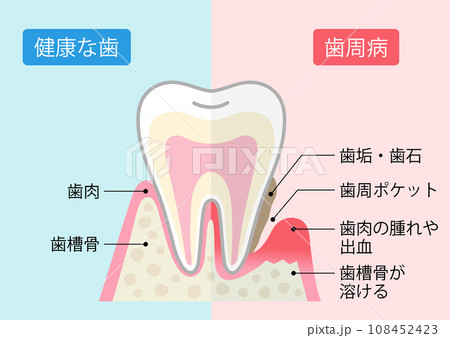 歯周病と健康な歯 比較 断面図 歯周病と健康な歯 比較 断面図 108452423