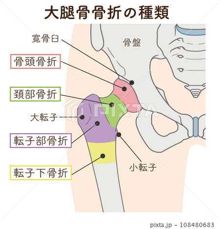 骨盤、大腿骨、骨折、大腿骨骨折、大腿骨頚部骨折、イラスト 骨盤、大腿骨、骨折、大腿骨骨折、大腿骨頚部骨折、イラスト 108480683