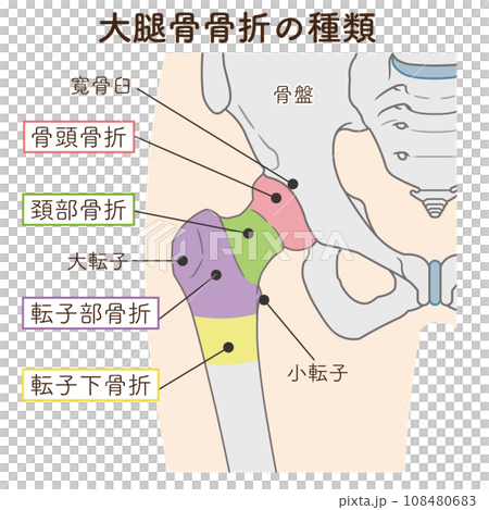 pelvis, femur, fracture, femur fracture, femoral neck fracture, illustration 108480683