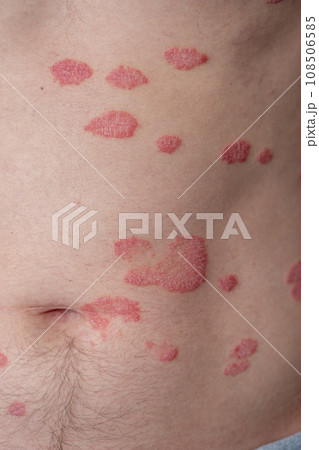 Psoriasis Vulgaris, skin patches are typically red, itchy, and scaly. Papules of chronic psoriasis vulgaris on male hand, back and body. Genetic immune disease. Detail of psoriatic skin disease Psoriasis Vulgaris, skin patches are typically red, itchy, and scaly. Papules of chronic psoriasis vulgaris on male hand, back and body. Genetic immune disease. Detail of psoriatic skin disease 108506585