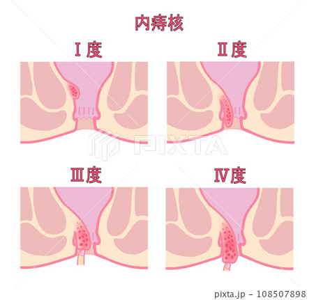 内痔核の進行度による分類のイラスト 内痔核の進行度による分類のイラスト 108507898