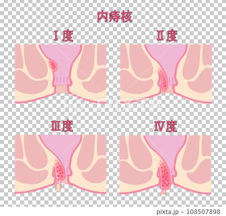 内痔核の進行度による分類のイラスト 内痔核の進行度による分類のイラスト 108507898