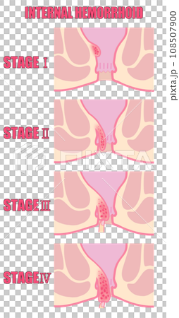 Illustration of classification of internal hemorrhoids by stage of progression 108507900