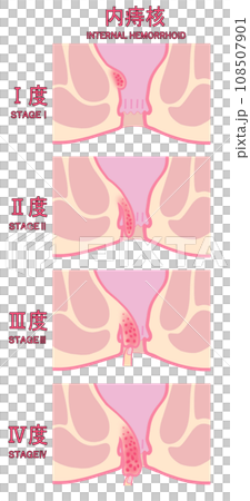 Illustration of classification of internal hemorrhoids by stage of progression 108507901