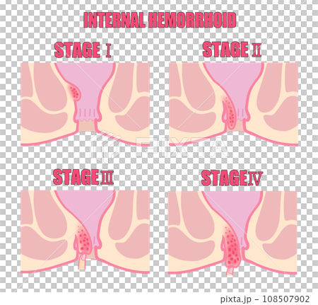 Illustration of classification of internal hemorrhoids by stage of progression Illustration of classification of internal hemorrhoids by stage of progression 108507902