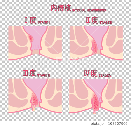 內痔依進展階段分類的圖示 內痔依進展階段分類的圖示 108507903