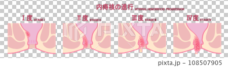 内痔核の進行度による分類のイラスト 108507905