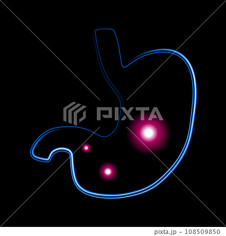 Vector isolated illustration of human stomach. Gas in the stomach. Stomach diseases. Ulcer. 108509850