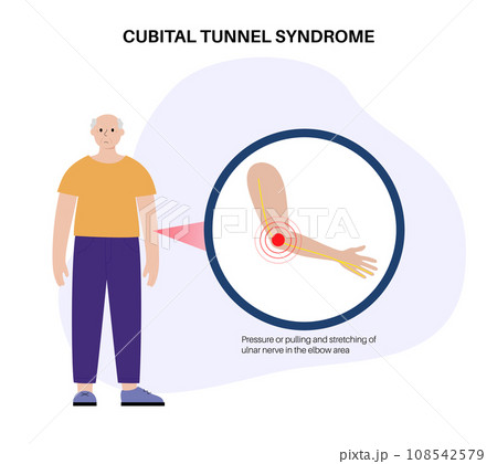 Cubital tunnel syndrome Cubital tunnel syndrome 108542579