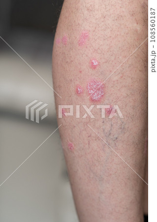 Psoriasis Vulgaris, skin patches are typically red, itchy, and scaly. Papules of chronic psoriasis vulgaris on male hand, back and body. Genetic immune disease. Detail of psoriatic skin disease  108560187
