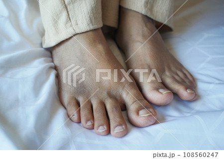 close up of women feet with swelling close up of women feet with swelling 108560247