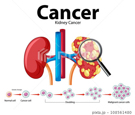 Cancer Development Process in Human Kidney: An Infographic 108561480