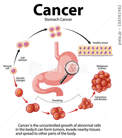 Stomach Cancer: Abnormal Cell Growth Infographic 108561482