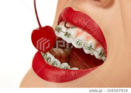Cropped photo. Extreme close up of woman in braces on teeth with red lips blowing smoke from mouth. Bad habits. No smoking or quit smoking. 108567919