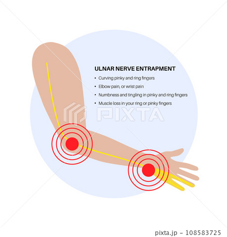 Ulnar nerve entrapment 108583725