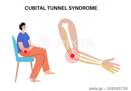 Cubital tunnel syndrome Cubital tunnel syndrome 108583730