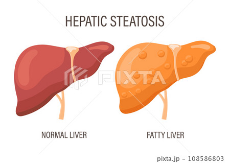 Liver steatosis, liver diseases. Healthy liver and fatty liver. Medical infographic banner. Vector Liver steatosis, liver diseases. Healthy liver and fatty liver. Medical infographic banner. Vector 108586803