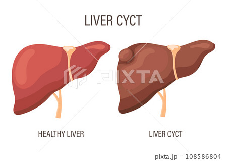 Liver cyst, liver disease. Healthy liver and liver cyst. Medical infographic banner. Vector 108586804