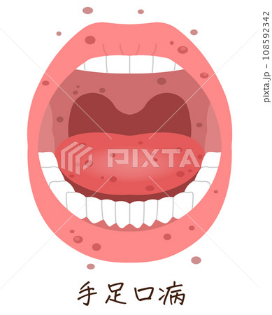 舌、歯、手足口病のイラスト、illustration 108592342