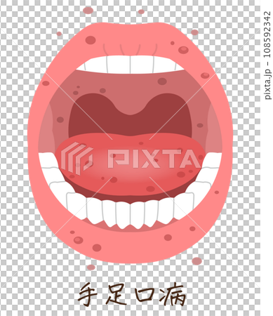 Tongue, teeth, hand, foot and mouth disease illustration, illustration 108592342