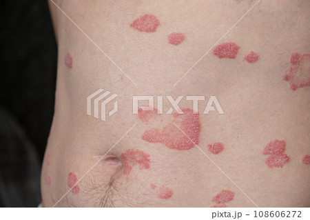 Psoriasis Vulgaris, skin patches are typically red, itchy, and scaly. Papules of chronic psoriasis vulgaris on male hand, back and body. Genetic immune disease. Detail of psoriatic skin disease Psoriasis Vulgaris, skin patches are typically red, itchy, and scaly. Papules of chronic psoriasis vulgaris on male hand, back and body. Genetic immune disease. Detail of psoriatic skin disease 108606272