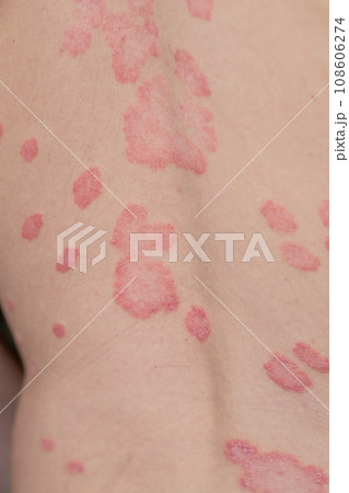 Psoriasis Vulgaris, skin patches are typically red, itchy, and scaly. Papules of chronic psoriasis vulgaris on male hand, back and body. Genetic immune disease. Detail of psoriatic skin disease  108606274