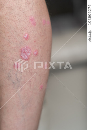 Psoriasis Vulgaris, skin patches are typically red, itchy, and scaly. Papules of chronic psoriasis vulgaris on male hand, back and body. Genetic immune disease. Detail of psoriatic skin disease Psoriasis Vulgaris, skin patches are typically red, itchy, and scaly. Papules of chronic psoriasis vulgaris on male hand, back and body. Genetic immune disease. Detail of psoriatic skin disease 108606276