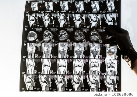 Knee joint x-ray or MRI. Doctor pointed on area of knee joint, where pathology or problem is detected, such fracture, destruction of joint, osteoarthritis. Knee joint x-ray or MRI. Doctor pointed on area of knee joint, where pathology or problem is detected, such fracture, destruction of joint, osteoarthritis. 108629096