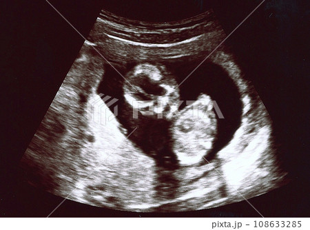 エコー写真 14週の写真素材 [108633285] - PIXTA
