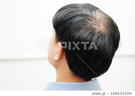 Bald head in man, hair loss treatment health problem. Bald head in man, hair loss treatment health problem. 108653504