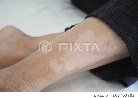 feet with vitiligo skin condition. feet with vitiligo skin condition. 108703583