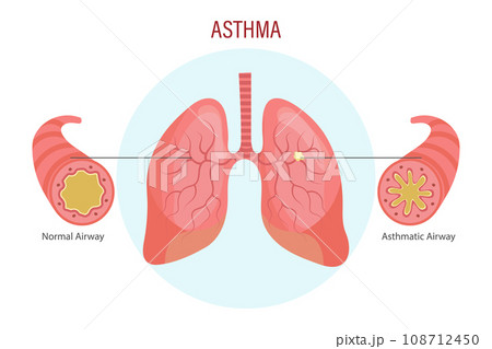 Asthma, lung disease. Medical infographic banner, illustration, vector Asthma, lung disease. Medical infographic banner, illustration, vector 108712450