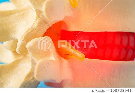 Red inflamed spine with a compressed nerve root, close-up. Neuralgia and radiculitis in diseases of the spine. Back pain, close-up 108738941