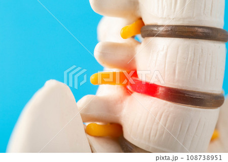 Red inflamed intervertebral disc herniation on a medical model of the spine, blue background. Diseases and treatment of hernias and protrusions, close-up 108738951
