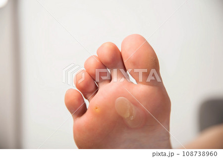 Human foot with a large callus and chicken jowl wart on a white background, close-up. Human papilloma virus 108738960