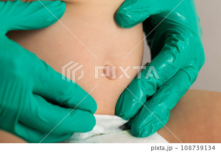 Doctor's hands in green medical gloves examine an umbilical hernia in a child, close-up. Doctor's hands in green medical gloves examine an umbilical hernia in a child, close-up. 108739134