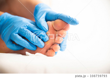 Doctor squeezing and removing a callus on the foot, close-up. Dermatoscopy Doctor squeezing and removing a callus on the foot, close-up. Dermatoscopy 108739793