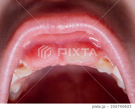 Swelling of the gums during the eruption of permanent teeth after the loss of milk teeth in children. Children's dentistry. Close-up 108740685