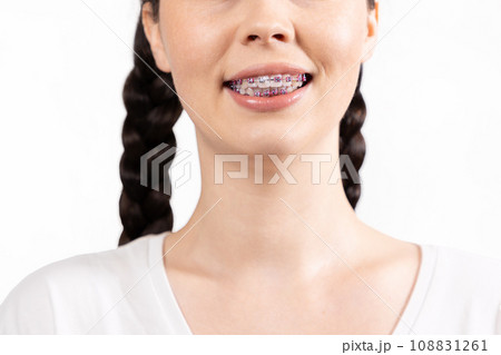 Close-up of smiling young woman with braces on her teeth. White background. Concept of orthodontic treatment Close-up of smiling young woman with braces on her teeth. White background. Concept of orthodontic treatment 108831261