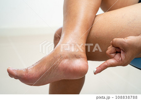 Asian woman care feet with cracked and dry heel skin cream at home. 108838788