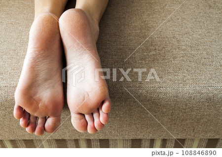 Dry cracked skin of woman feet in bed. Foot treatment. Dry cracked skin of woman feet in bed. Foot treatment. 108846890