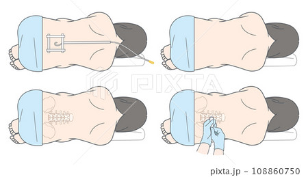 硬膜外麻酔・くも膜下麻酔・無痛分娩のイラスト 硬膜外麻酔・くも膜下麻酔・無痛分娩のイラスト 108860750