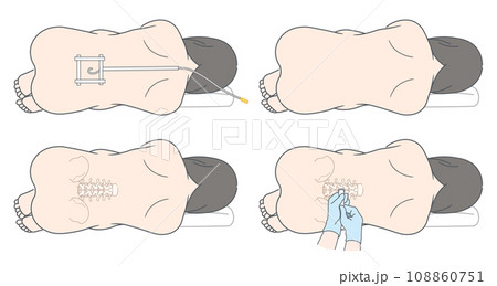 硬膜外麻酔・くも膜下麻酔・無痛分娩のイラスト 108860751