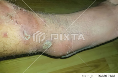 Diabetes mellitus wound, blisters, boils, infections, rash of the foot. Infected wound, treatment of a diabetic patient's leg infection. skin itchy, skin disease, skin problems 108861488