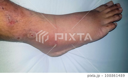 Diabetes mellitus wound, blisters, boils, infections, rash of the foot. Infected wound, treatment of a diabetic patient's leg infection. skin itchy, skin disease, skin problems 108861489