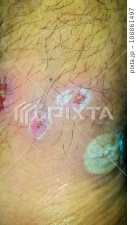 Diabetes mellitus wound, blisters, boils, infections, rash of the foot. Infected wound, treatment of a diabetic patient's leg infection. skin itchy, skin disease, skin problems Diabetes mellitus wound, blisters, boils, infections, rash of the foot. Infected wound, treatment of a diabetic patient's leg infection. skin itchy, skin disease, skin problems 108861497